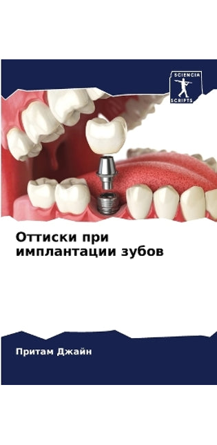 Оттиски при имплантации зубов